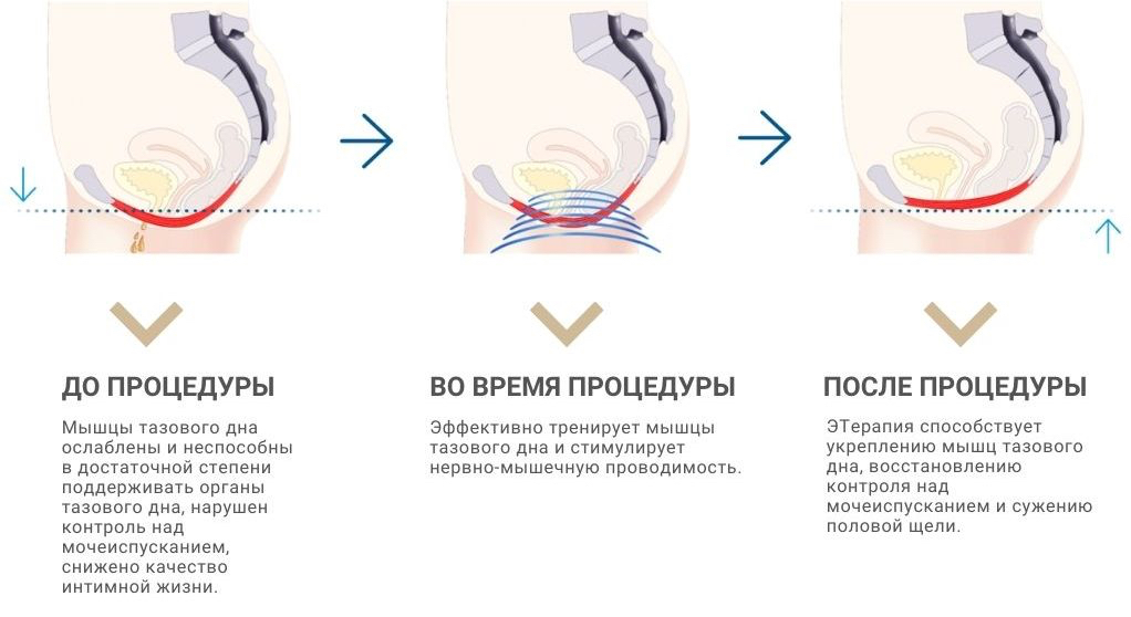 Трон "КЕГЕЛЯ" стимуляция мышц тазового дна, аппарат "EMSzero" Краснодар.