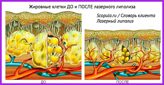Лазерный липолиз Краснодар салон аппаратного массажа Gertrude
